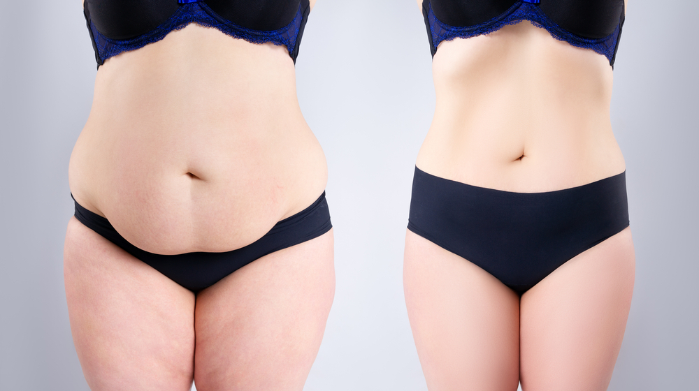 Tummy Tuck Versus Liposuction: What You Should Know: ReJuv MedSpa