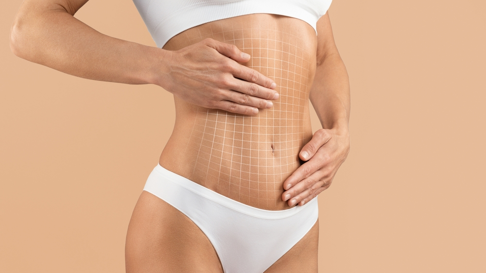 A Guide to Getting a Tummy Tuck Covered by Insurance